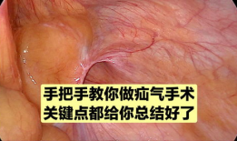 疝气手术视频,从术前准备到术后恢复