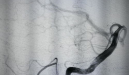 造影视频全过程,揭示血管奥秘与诊疗过程